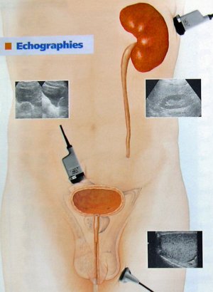 L'échographie de l'appareil urinaire : qu'est-ce que c'est ?